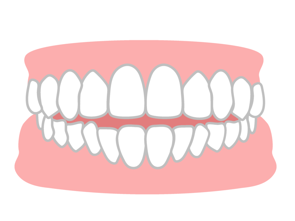 開咬